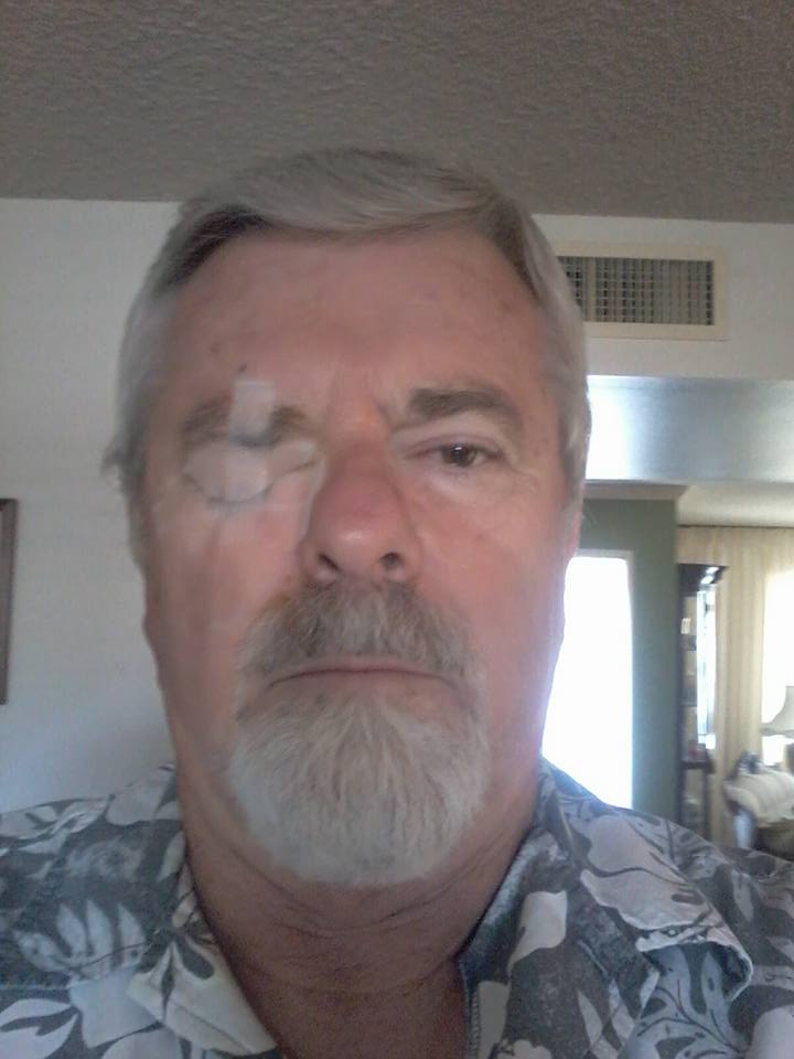 I got the second cataract removed today.  All went well.